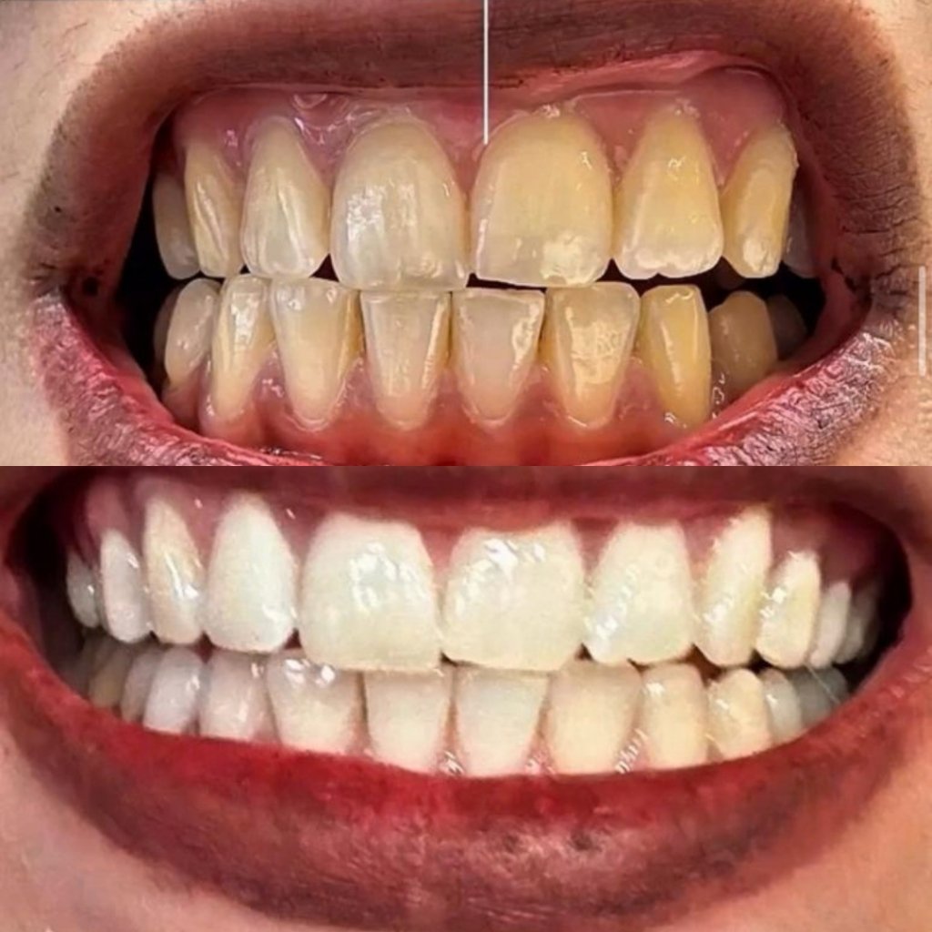 Cosmetic smile makeover and porcelain veneers patient result at Smile And Skin Co.