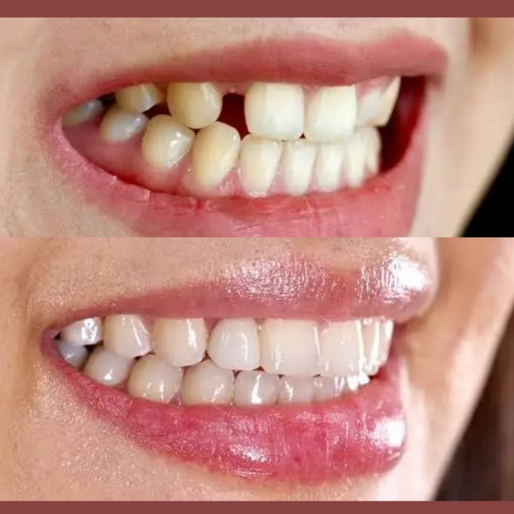 Dental implant and anterior tooth replacement patient result at Smile And Skin Co.