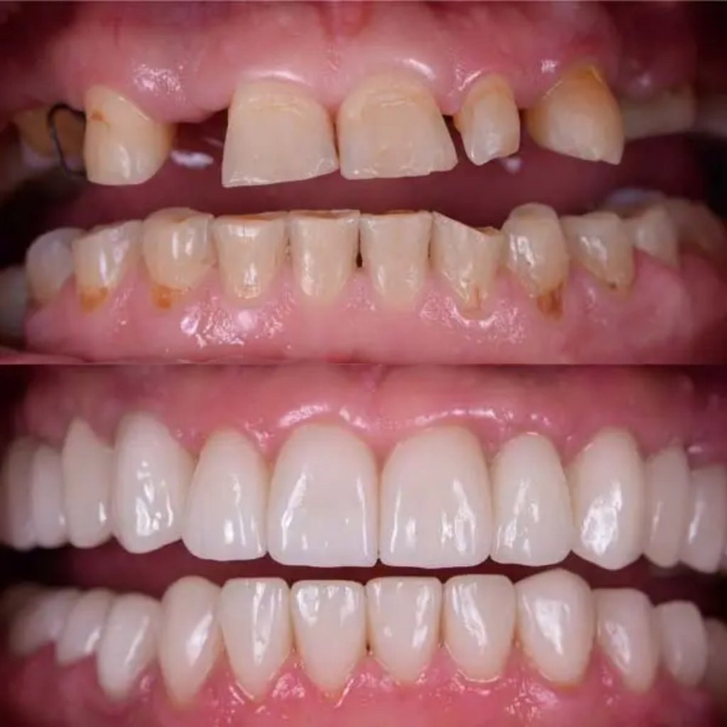 Full arch restorative ceramic rehabilitation patient result at Smile And Skin Co.