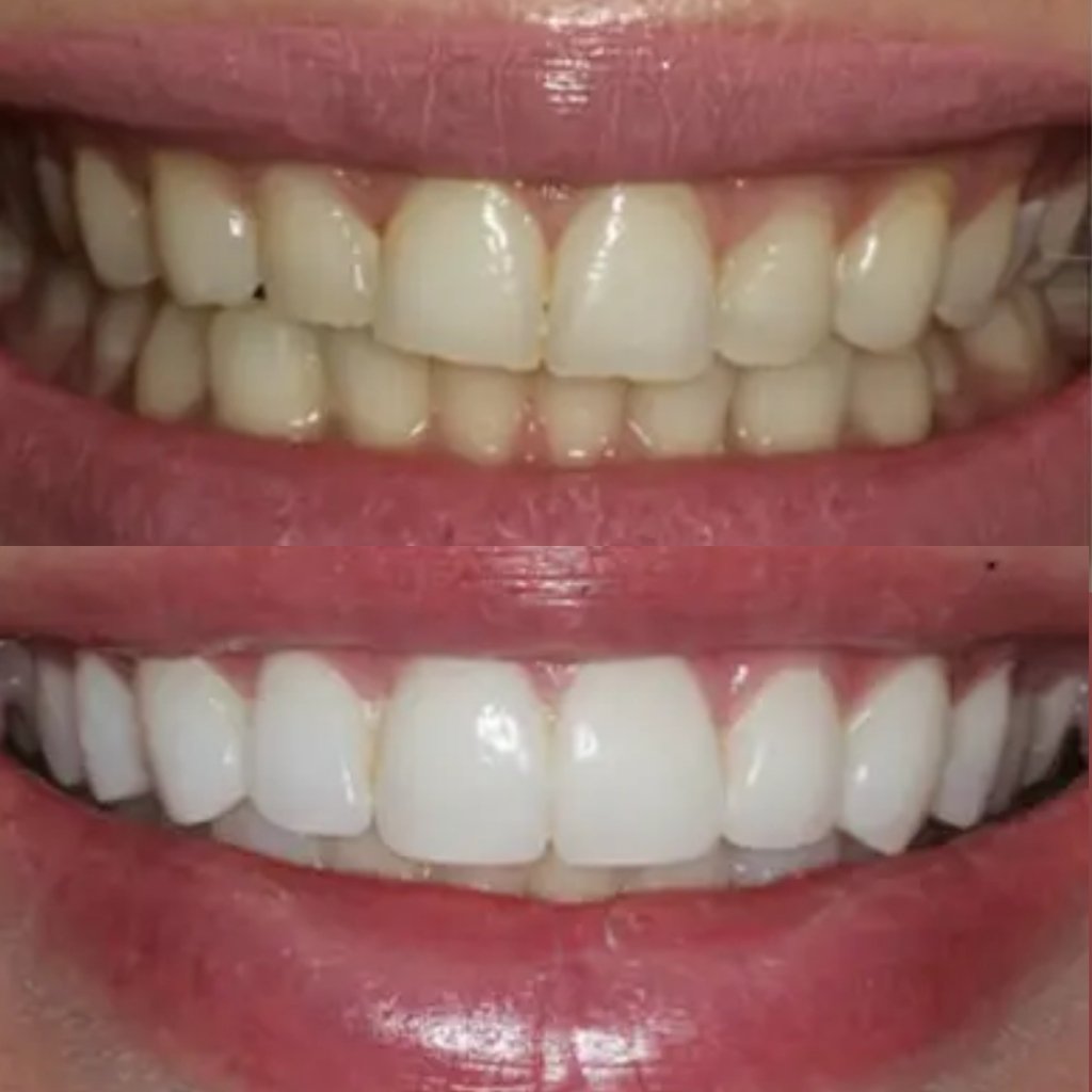 Professional in-chair teeth whitening shade lifting before and after at Smile And Skin Co.