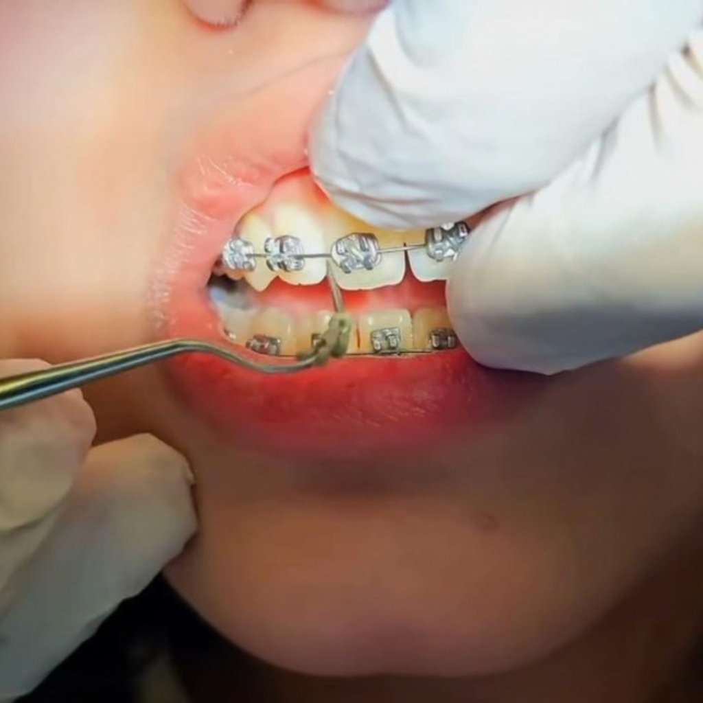 Orthodontic braces adjustment and tooth alignment at Smile And Skin Co.
