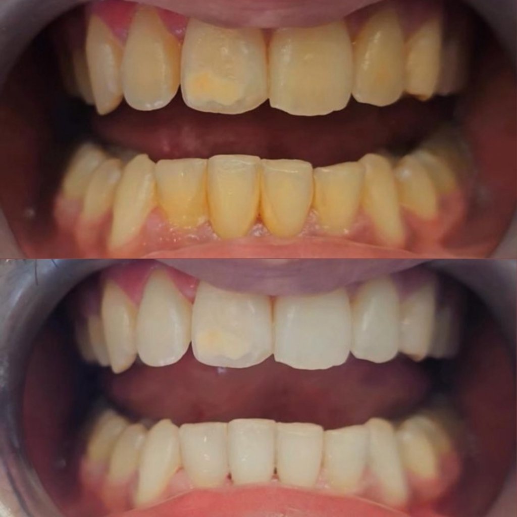 Clinical in-chair whitening shade comparison at Smile And Skin Co.